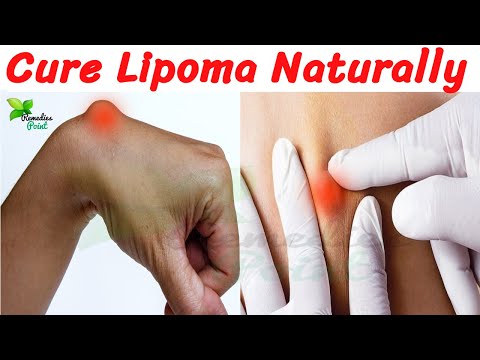 How to Cure Lipoma Naturally | Home Remedies for Lipoma | How to Remove a Cyst at Home