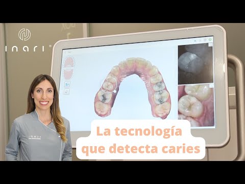 Detecta las caries – Tecnología NIRI