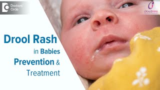 DROOL RASH IN BABIES : Causes & Treatment-Dr.Spoorti Kapate of Cloudnine Hospitals | Doctors