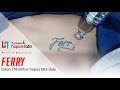 Hapus Tato Di Dada Dengan PicoSure Laser Rumah Hapus Tato