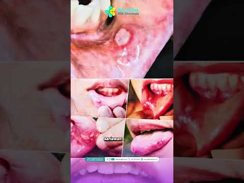Waspada Sariawan yang tak sembuh sembuh bisa jadi kanker mulut