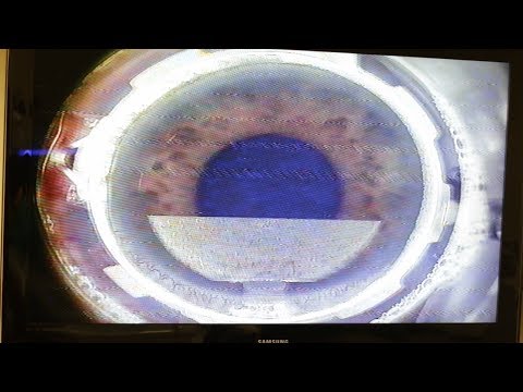 Pierwszy etap laserowej korekcji wzroku metodą Femtolasik - Voigt Medica