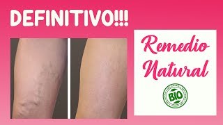 Remedio Casero para Varices