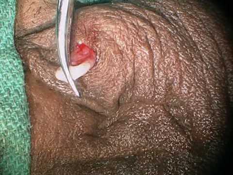 No-Scalpel Vasectomy 