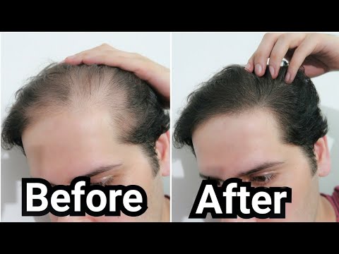 How I Grew Back my Hair with Rosemary Oil (My Results...