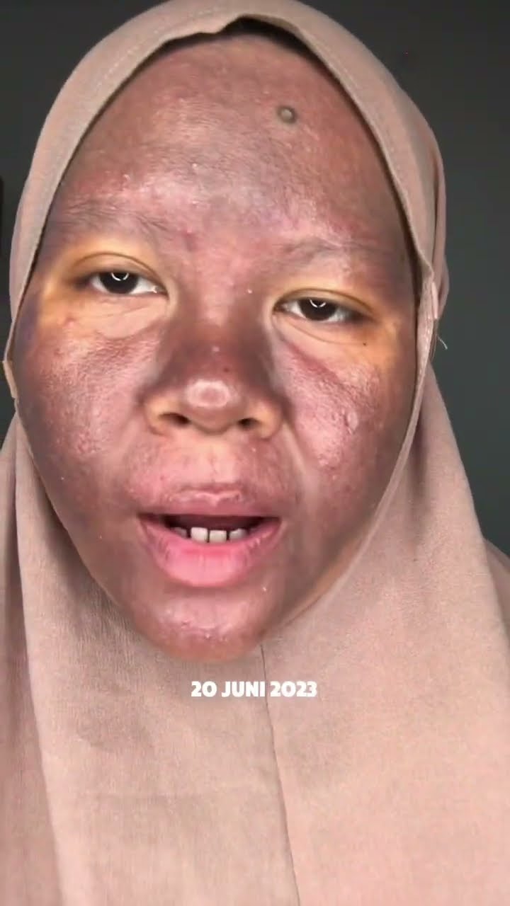 Kini saatnya bangkit dari dampak merkuri! 🌿✨ Yuk, temukan rahasia merawat kulit yang sehat dan bersinar!