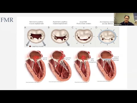 Surgical and Percutaneous Mitral Valve Therapies by Professor Ehud Raanani, MD
