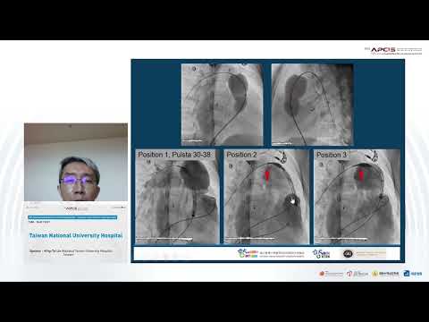 Failed&Well-done Cases of PPVI PA-IVS s/p Valvotomy Moderate to severe PR