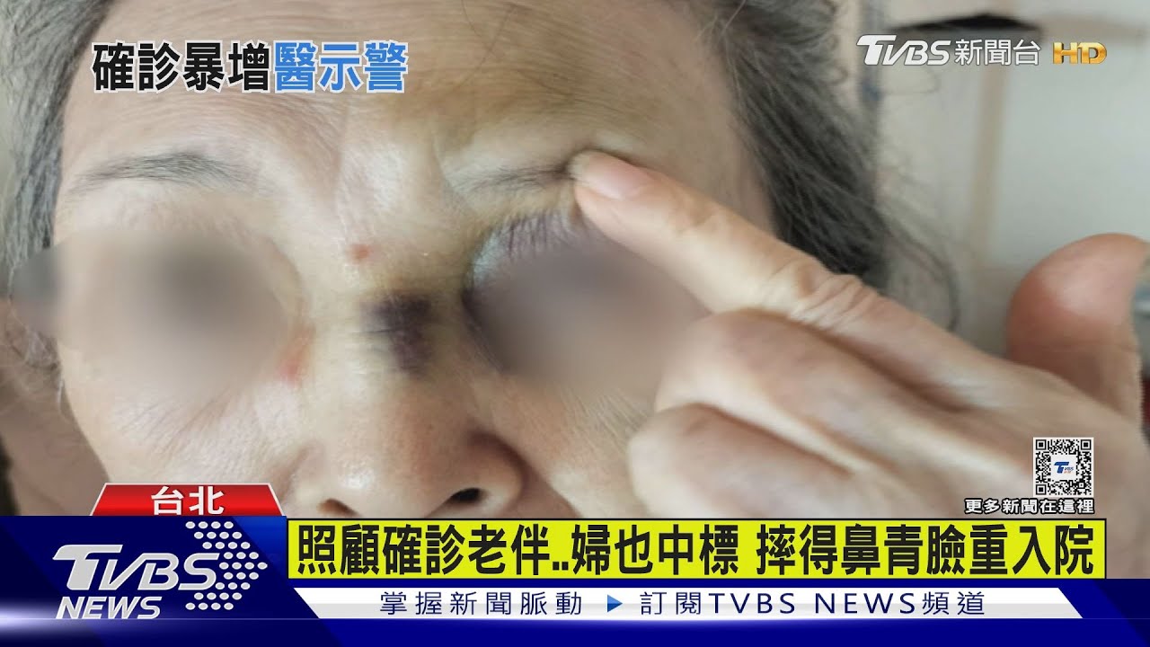 照顧確診老伴 婦也中鏢摔得鼻青臉腫入院