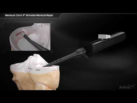 Meniscal Cinch II™ All-Inside Meniscal Repair