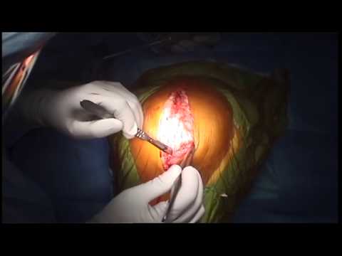 Revision Total Knee Replacement