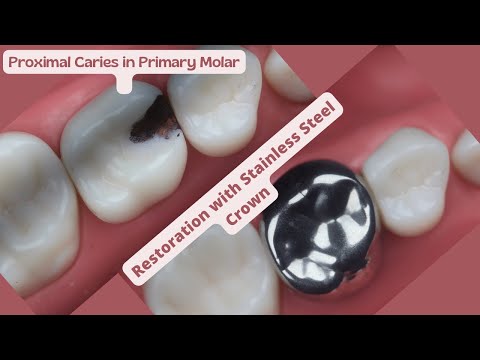 How To Restore Primary Molar with Proximal Caries | Stainless Steel Crown Restoration | 3 Steps