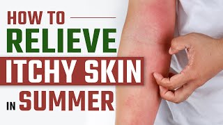 How to Relieve Itchy Skin in Summer | Home Remedies for Skin Allergy and Itching | Dr Health