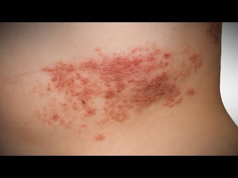 Rote Augen und Osteochondrose Rückenschmerzen nach auf einer harten Matratze schlafen