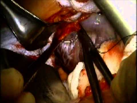 Large Left Myxoma Resected by Minimally Invasive Techniques. Narration by the operating surgeon.