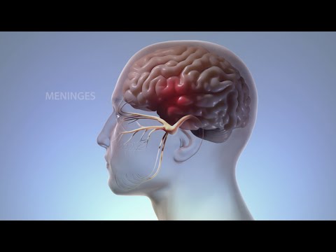 Inside a Migraine: The Body's Response to an Attack | WebMD