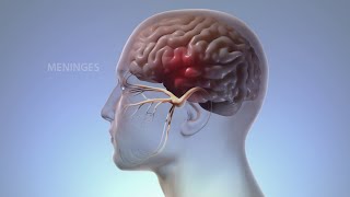 What Happens In Your Body During Migraine | WebMD