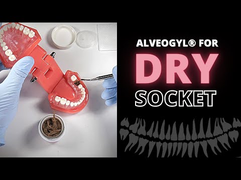 Using Alveogyl To Relieve Dry Socket Pain (Alveolar Osteitis)