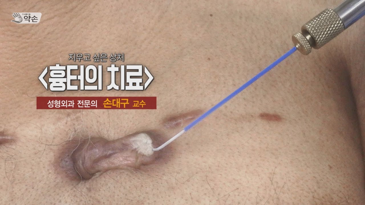 지우고 싶은 상처 '흉터의 치료'ㅣ성형외과 손대구 교수 관련사진