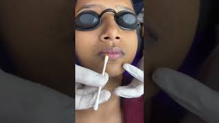 Dark lips Peel Treatment