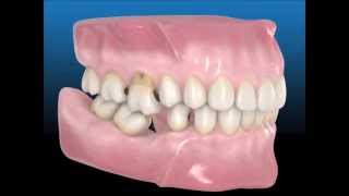 Las consecuencias de la pérdida dentaria ¿Por qué es importante colocarte el implante dental