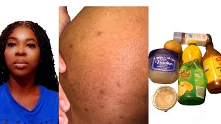 how to get rid of pimples, scars, dark spots on buttocks.