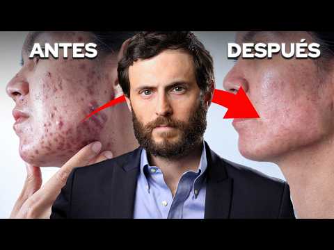 Resuelve el ACNÉ de Esta Manera