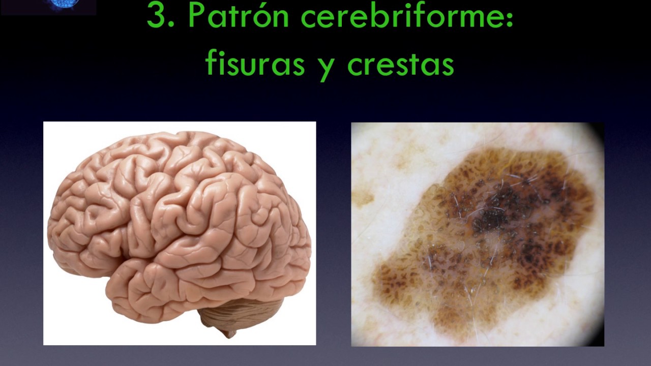 Queratosis seborreicas : un simulador de melanoma - Dra. Alejandra Larre Borges