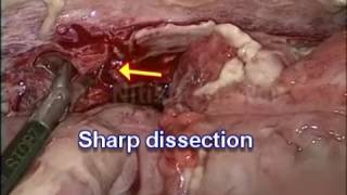Laparoscopic Surgery (Appendectomy) for Complicated Appendicitis (Perforation Peritonitis)