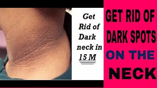 Get Rid Of Dark Spots On The Neck, Underarms And Between Legs In Just 15 Minutes!