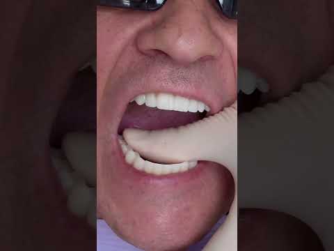 Dental implant&rsquo;s All on 4 in Prague #shorts #dentist #dental #implant #veneers #short