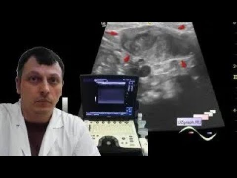 Pediatric soft tissues ultrasound of the neck - torticollis / neoplasia