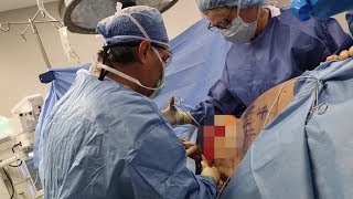 My No-Drain Tummy Tuck Study Results: Why It's Better 