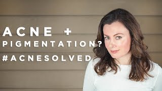 Acne Marks, Scarring & PIH? Everything To Know! #AcneSolved - Part 3 | Dr Sam Bunting