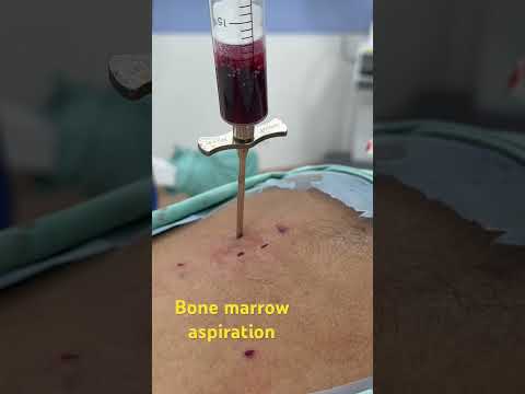 Endoscopic Spine Surgery: Life-Changing | Dr. Ajay Kothari