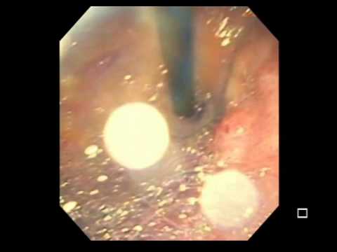 Signet Ring Gastric Cancer of Remnant Stomach Following Gastric Bypass