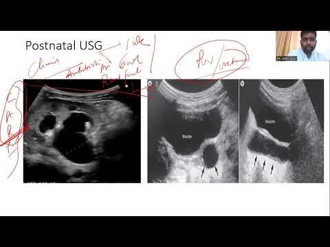 Antenatal hydronephrosis | Evaluation and Postnatal Management | Approach to Hydronephrosis in Child