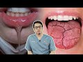 Penyakit Air Liur Kurang Dan Terlebih