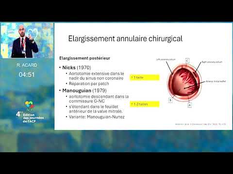 Sténose aortique avec petit anneau : quels choix prothétiques ?