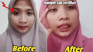 Download lagu CARA MENGOBATI KALAZION X BINTITAN TANPA OPERASI Ampuh 100% Real Story mp3 Download lagu CARA MENGOBATI KALAZION X BINTITAN TANPA OPERASI Ampuh 100% Real Story mp3