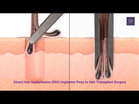 Implanter Pens In Hair Transplant Surgery