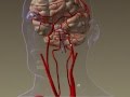 Stroke Artery Clot