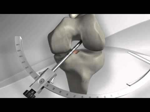 Metodë e Rikonstruksionit të ACL   Medial Portal Transfix®