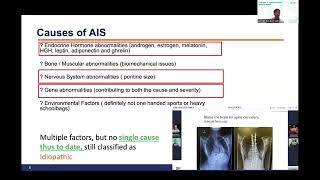 I've got a Curved Spine, What's Next? Public Webinar