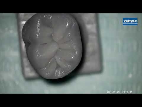 Реставрация зуба 3.6 от Ивана Рузина
