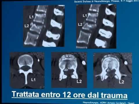 Esercizio Gitta in osteocondrosi Vitamine per giunti di omega 3