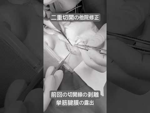 医学科 二重切開の他院修正•手術動画