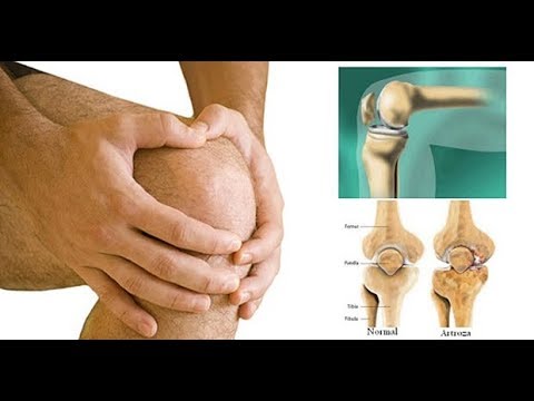 artrita artroso a articulațiilor interfalangiene)