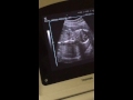 Audrey ultrasound by mistake baby boy but its a baby girl...