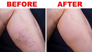 💢 Spider Veins on the Leg or Face - Natural Treatments